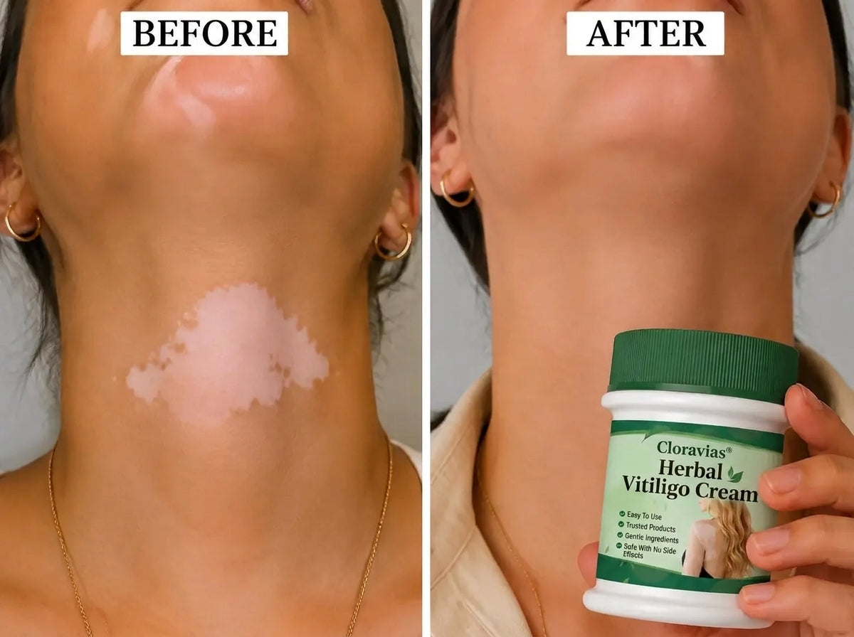 Cloravias® Targets Vitiligo to Restore Visible Skin Pigment
